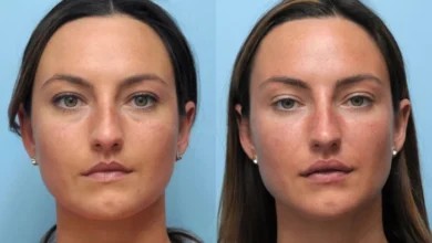 The Art of Thread Lift by the Best Doctors in Dubai