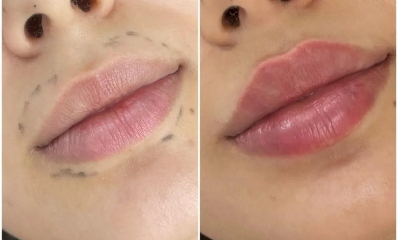 Juvederm