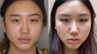 Buccal Fat Removal