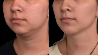 Double chin removal
