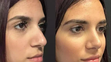 septoplasty in dubai