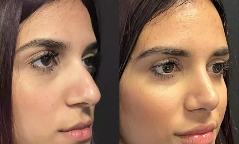 septoplasty in dubai