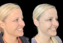 Wrinkle-Free Confidence from the Best Plastic Surgeon in Dubai for Botox