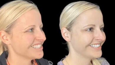 Wrinkle-Free Confidence from the Best Plastic Surgeon in Dubai for Botox