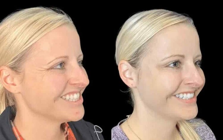 Wrinkle-Free Confidence from the Best Plastic Surgeon in Dubai for Botox
