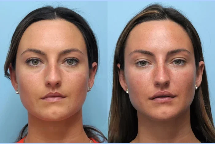Before and After Magic by the Best Plastic Surgeon in Dubai for Thread Lift